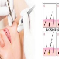 Effective Is Electrolysis Compared to Laser Hair Removal