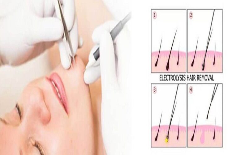 Effective Is Electrolysis Compared to Laser Hair Removal