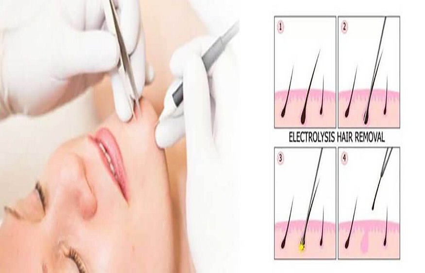 Effective Is Electrolysis Compared to Laser Hair Removal